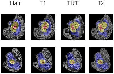 MRI brain tumor segmentation using residual Spatial Pyramid Pooling-powered 3D U-Net